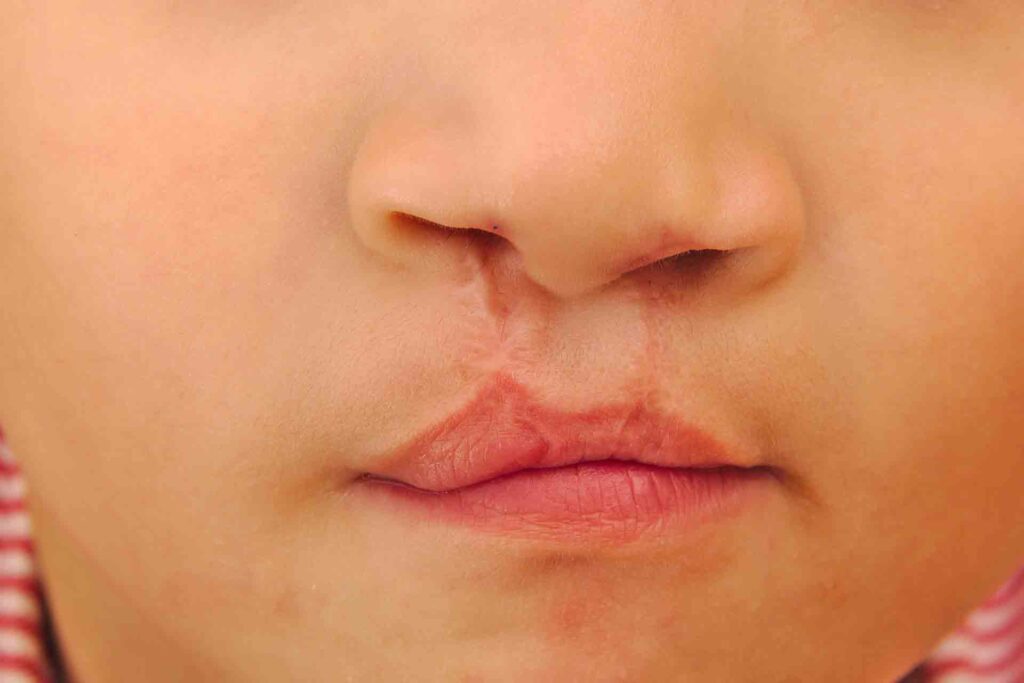 Orofacial myofunctional disorders disturb the tongue position during rest, swallowing, and speech.