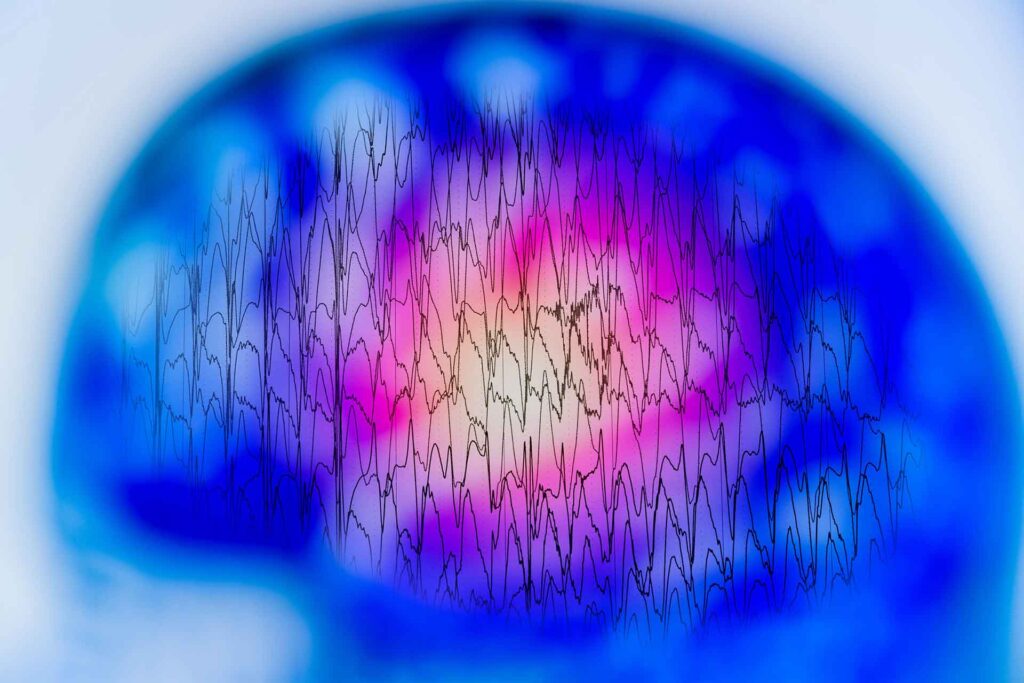 During epilepsy, the person engages in seizures, abnormal behaviors, loss of sensation and awareness. It affects brain activity.