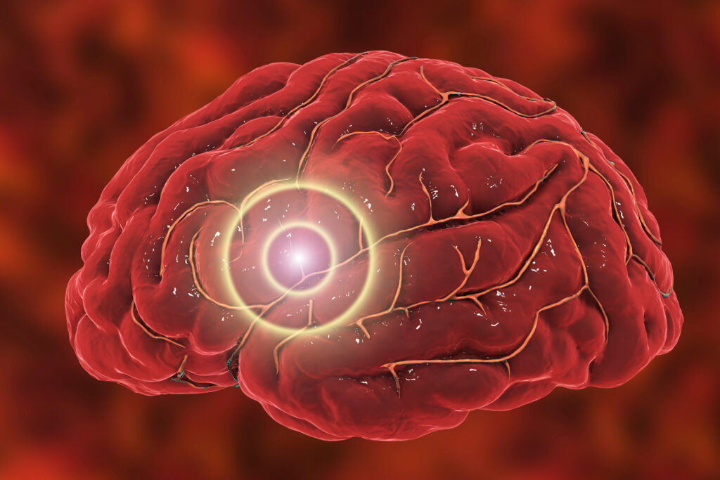 A stroke is a brain injury caused by a blocked or burst blood vessel in the brain. The consequences vary depending on its location in the brain.